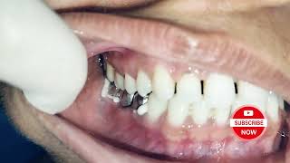 Cementation of Bridge 454647 painless dentist [upl. by Marj]