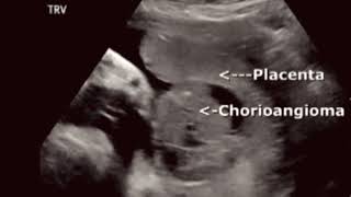 Chorioangioma ultrasound [upl. by Oliver]