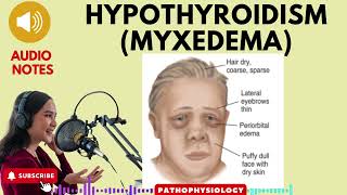 Hypothyroidism Myxedema Causes SignsSymptoms amp treatment [upl. by Avle]