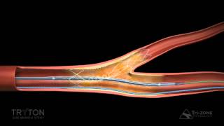 Tryton Side Branch Stent Deployment Sequence [upl. by Anaidni]