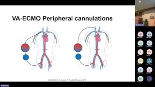 ECMO Dr Giselle Baquero Society of Mechanical Ventilation Conference 2023 [upl. by Eiral285]