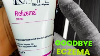 Goodbye Dyshidrotic eczematous dermatitis using this eczema [upl. by Sacrod]