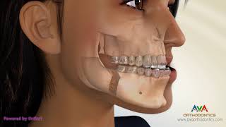 Surgical Orthodontic Treatment for Underbite or Crossbite  Transcortical Mandibular Setback [upl. by Ary]