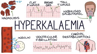 Understanding Hyperkalaemia High Potassium [upl. by Icrad]