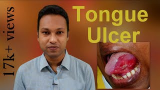 Tongue Ulcer Aetiologies amp Diagnostic Approach [upl. by Anissej]