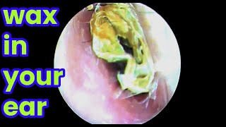 Ear picking Cleaning earwax asmr ear cleaning wax in your ear Ear health  ear piercing cleaning [upl. by Pennebaker270]