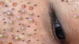 Relax Every Day With Loan Nguyen Spa  Acne Treatment Pimple Popping 44 [upl. by Scherle118]