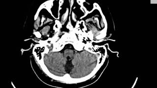 CASE 348 CT BRAIN LACUNAR AND BASAL GANGLIA INFARCTION ATROPHIC CHANGES [upl. by Raval]