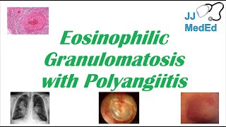 Eosinophilic Granulomatosis with Polyangiitis EGPA  ChurgStrauss Syndrome Autoimmune Vasculitis [upl. by Thomasa658]