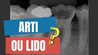 ARTICAÍNA OU LIDOCAÍNA PARA ANESTESIA INTRALIGAMENTAR EM MOLAR INFERIOR  QUICK TIP ENDOLOVERS [upl. by Eynttirb]