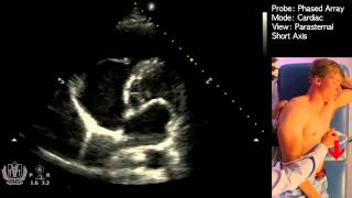 Parasternal Short Axis View  Transthoracic Echocardiography Ultrasound [upl. by Yelhsa]