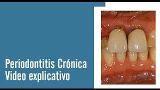 Periodontitis Crónica  Juan Salgado  Enfermedades Periodontales  Video explicativo [upl. by Stucker]