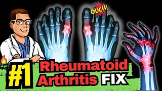 The Best Natural Treatment for Rheumatoid Arthritis [upl. by Zetes]