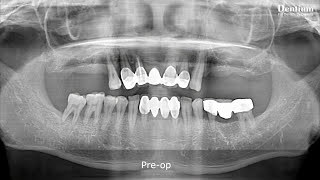 Intentional sinus perforation and pus drainage  Dr Park Wonbae Short [upl. by Huckaby]