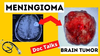 What Is A Meningioma Tumor [upl. by Ailsun230]