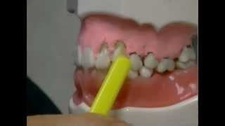 What Causes Gum Recession and How To Treat It [upl. by Jacquenetta]