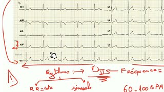 ECG  trouble du rythme et fréquence prt 1 [upl. by Aicilev]