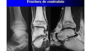 Imagerie médicale en pathologie sportive de l’enfant et de l’adolescent [upl. by Eisac121]