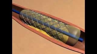 ballonnet et stent  angioplastie coronaire percutanée [upl. by Budwig355]