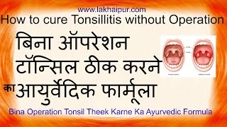 How to cure tonsils naturally  Tonsils ka gharelu elaaj  टॉन्सिल ठीक करने आयुर्वेदिक फार्मूला [upl. by Leasa]