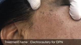 Dermatosis Papulosa Nigra Removal DPN Removal Poise Skin Clinic [upl. by Naomi418]