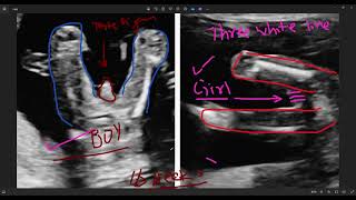 12 week ultrasound  sonography se kaise jane ladka hai ya ladki  6 week ultrasound  trimester [upl. by Alurta]