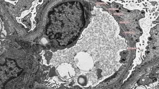 Nephrotic Syndrome  Pathology mini tutorial [upl. by Choo]