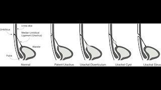 Results of Patent urachus Urachal cyst urachal sinus Diverticulum urachal fistula [upl. by Fillian911]