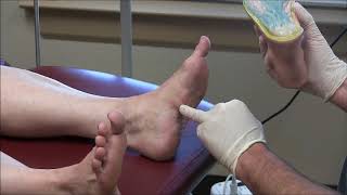 Painful Plantar Fibromas in Feet [upl. by Ytsihc]