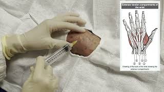 Wrist Arthrocentesis [upl. by Hamnet]