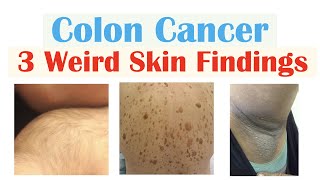 3 Weird Signs of Colon Cancer Found on the Skin [upl. by Brock]