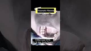 Traumatic Fibroma Laser Treatment  Dr Mae Abella [upl. by Htebzile]