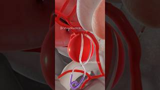 Brain Aneurysm Removal 3D Animation [upl. by Assenat]