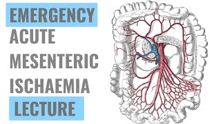 Mesenteric Ischaemia  Detailed explanation  Emergency Medicine [upl. by Donn]