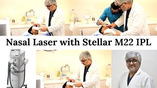 Nasal Laser with Stellar M22 IPL  Advanced wellness [upl. by Ecissej158]