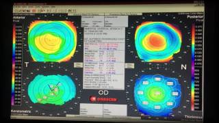 Topografía Corneal [upl. by Iggep]