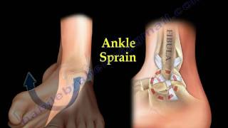 Ankle Pain ankle ligaments sprain  Everything You Need To Know  Dr Nabil Ebraheim [upl. by Baptiste112]