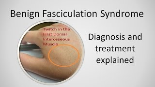 Benign Fasciculation Syndrome Causes and Treatment [upl. by Sylvie]