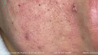 Big Cystic Acne Blackheads Extraction Blackheads amp Milia Whiteheads Removal Pimple Popping [upl. by Rodd954]