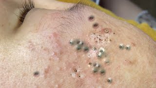 Big Cystic Acne Blackheads Extraction Blackheads amp Milia Whiteheads Removal Pimple Popping 95394 [upl. by Acillegna]