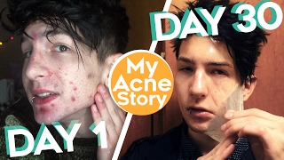 How I Cleared My Acne in 30 Days [upl. by Ylrebnik]