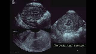 sonography of Ectopic Pregnancy [upl. by Jarad]