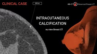 nuview Breast CT Visualization of Intracutaneous Calcification [upl. by Navinod]