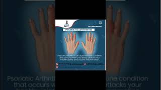 Psoriatic arthritis treatment [upl. by Roze]