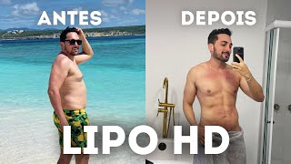 RESULTADO LIPO HD MASCULINA  Antes e depois da cirurgia de alta definição com Argoplasma e Morpheus [upl. by Eicarg577]