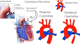 Coarctation of the Aorta  Symptoms Diagnosis and Treatment [upl. by Ellehcan]