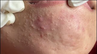 Acne Treatment Huong Da Nang600  2024 whiteheads [upl. by Ferna]