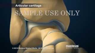 Arthroscopic Ankle Fusion Surgery Arthrodesis [upl. by Asirram]