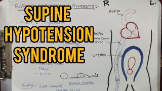 Supine Hypotension syndrome  Femoral vein Pressure  Position during pregnancy [upl. by Kale]