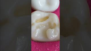 INCREDIBLE Tooth Filling toothcavity shorts [upl. by Ahsot]